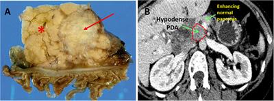 Metabolic Dependencies in Pancreatic Cancer